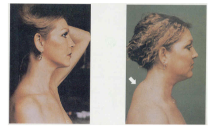 <p><span style="background-color: transparent;"><u><span>Cushing’s Syndrome</span></u></span></p>