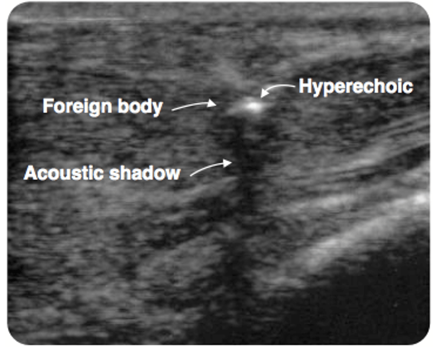 <p>• Readily available</p><p>• Cheapest modality</p><p>• Portable - can be used in clinic or theatre</p><p>• Excellent for visualising wooden FB's which are radiolucent on x-ray</p><p>• Real-time modality, so tissue movement can be used to aid detection</p><p>• Sterile gel is available when wounds complicate achieving optimal skin contact by the transducer</p>