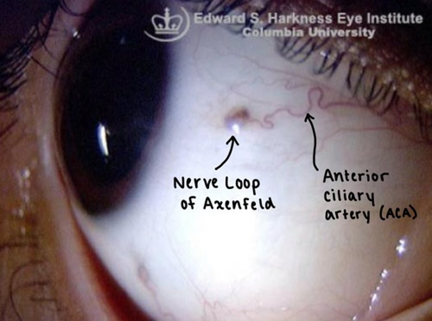<p>a branch of the <strong>Long ciliary nerves</strong> reaches the surface of the sclera, forming a visible nodule.</p><p></p><p>the <strong>Anterior ciliary artery</strong> can be seen near the nerve loop.</p>