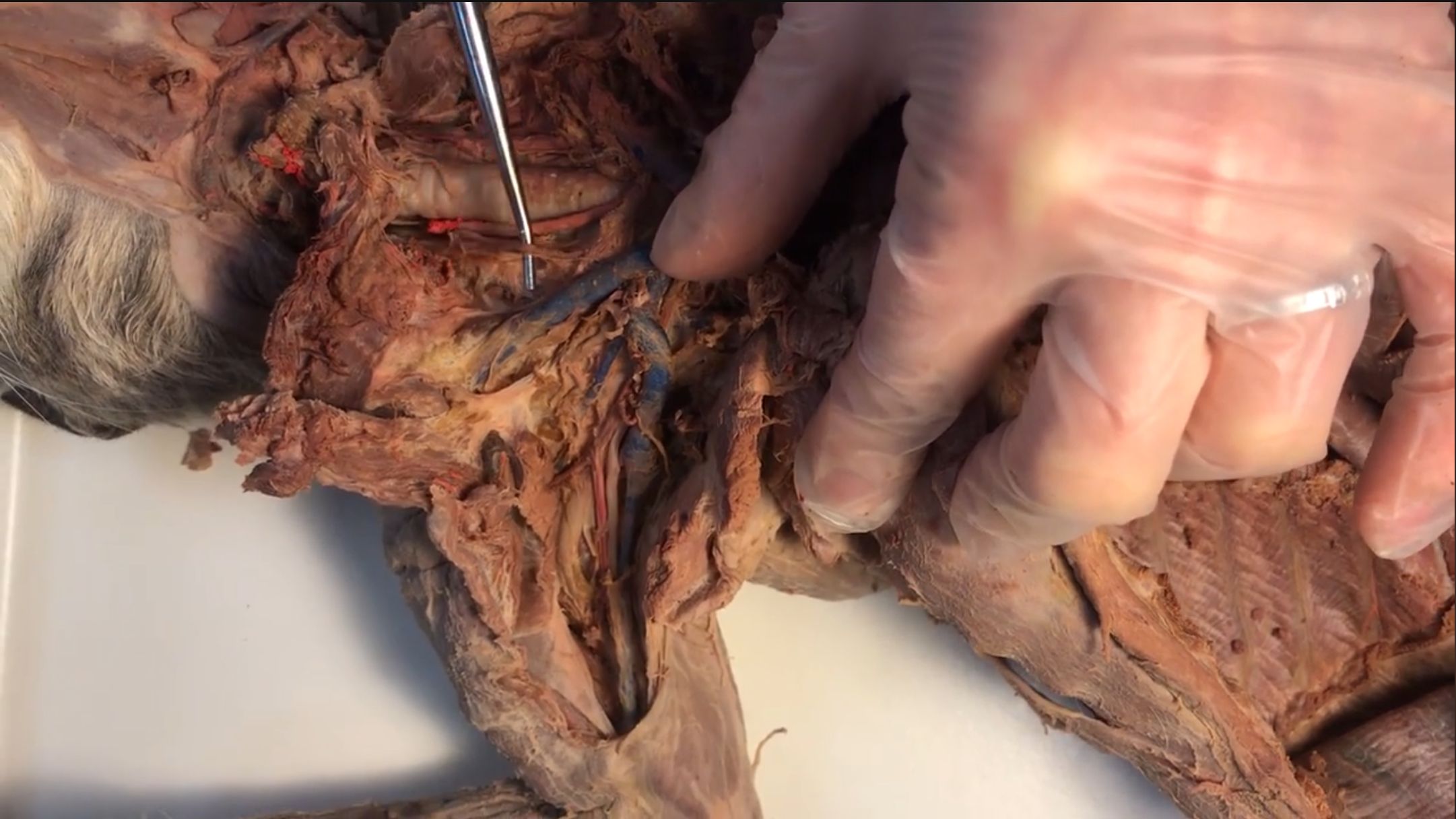 <p>What vein is this</p>