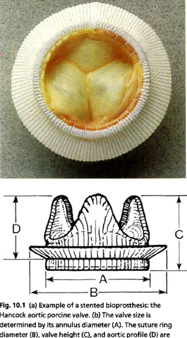 <p>sclerosis </p><p>echogenic annulus in stented valves </p>
