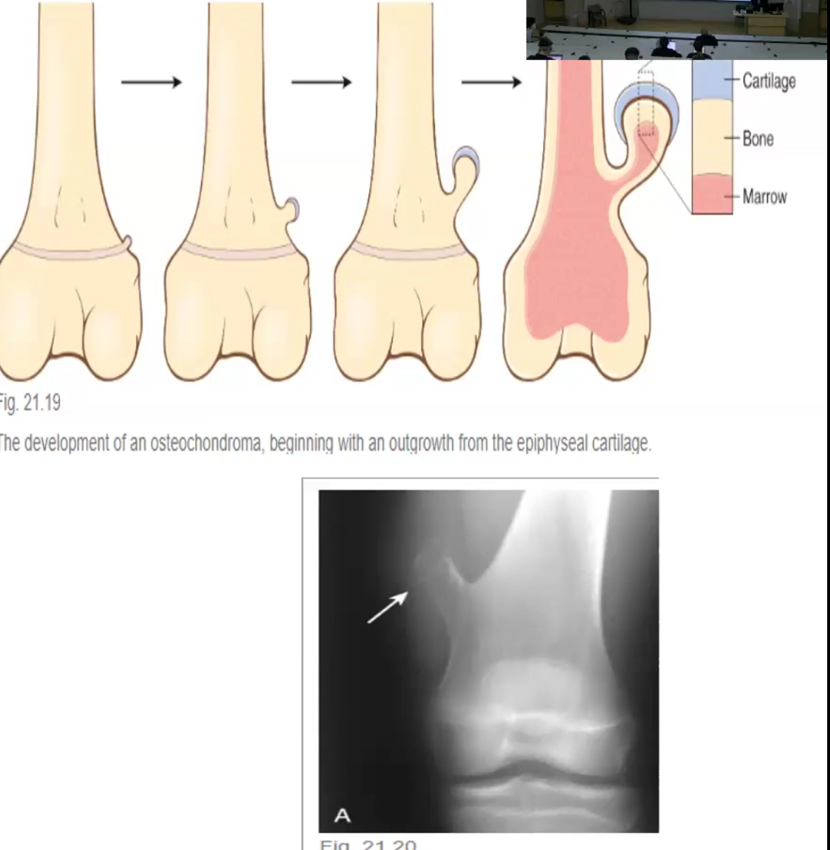 <ul><li><p>Most are benign</p></li><li><p>Affect young people</p></li><li><p>Most common type is osteochondroma:</p><ul><li><p>Benign bony outgrowths with a cartilage cap in the metaphysis of long bones</p></li><li><p>Usually solitary</p></li></ul></li></ul><p></p>