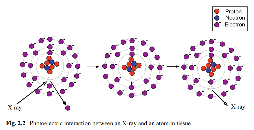 <p>Photoelectric attenuation is the absorption of X-rays when an incident photon interacts with an atom, causing a tightly bound electron to be emitted and the X-ray energy to be completely absorbed.</p><p>An electron from a higher energy level fills the "hole" left by the emitted electron, releasing energy that is absorbed elsewhere in the tissue, resulting in the complete absorption of the X-ray photon.</p>