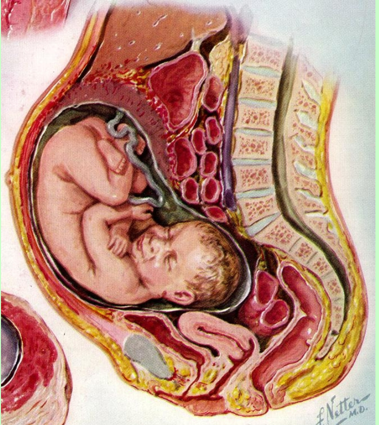 <p>Ectopic pregnancy</p>