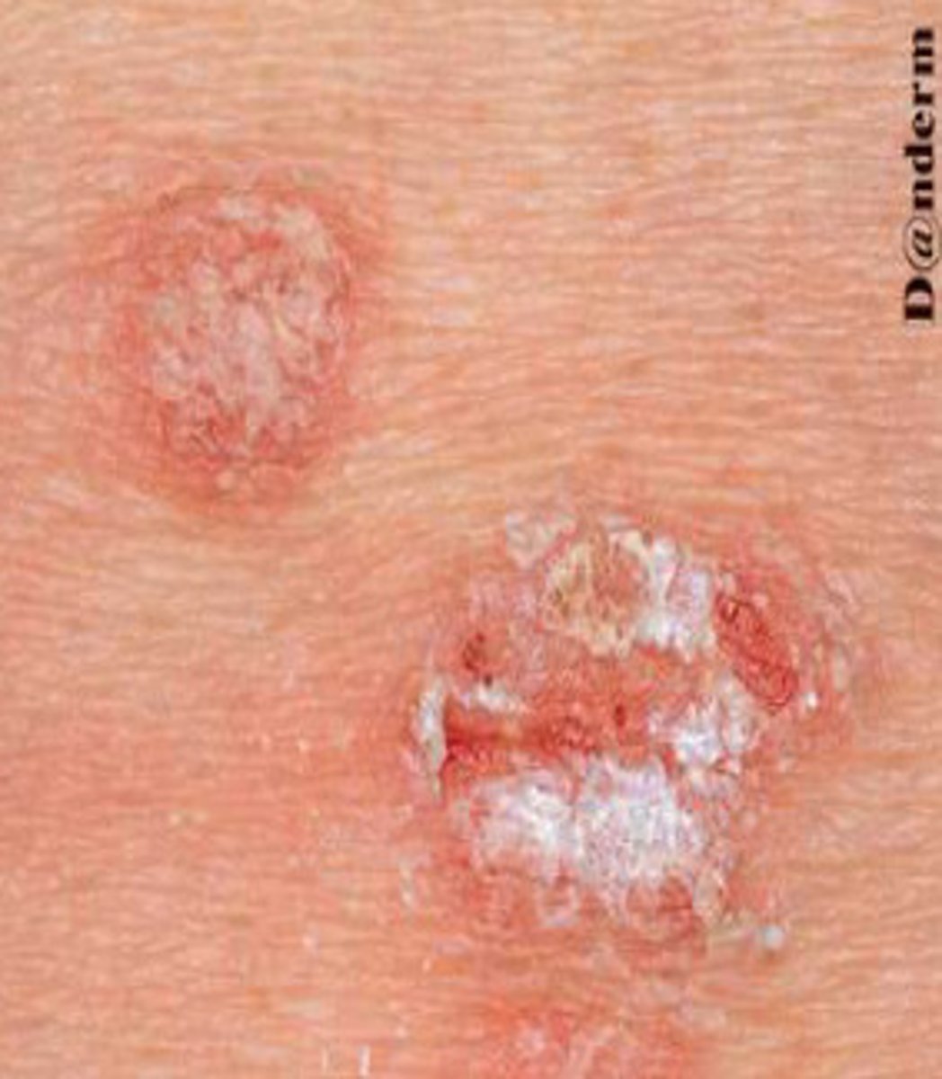 <p>name this manifestation and where it is seen</p>