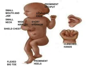 <ul><li><p>low set ears</p></li><li><p>small jaw </p></li><li><p>prominent occiput</p></li><li><p>congenital heart defects </p></li><li><p>syndactylyl </p></li></ul>