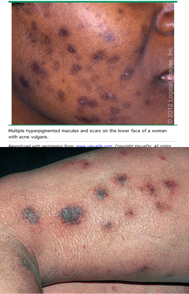 <p>reactive melanosis that occurs as a sequela of cutaneous inflammation; hyperpigmented macule or papules</p>