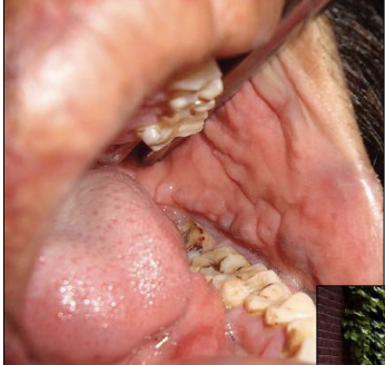 <ol><li><p>Diffuse, nodular swellings</p></li><li><p>“Cobblestone appearance” of the oral mucosa</p></li><li><p>Linear ulcerations of the buccal vestible</p></li><li><p>Treatment: sulfa drug/ prednisome</p></li><li><p>Oral lesions clear with treatment of GI disease</p></li></ol><p></p>