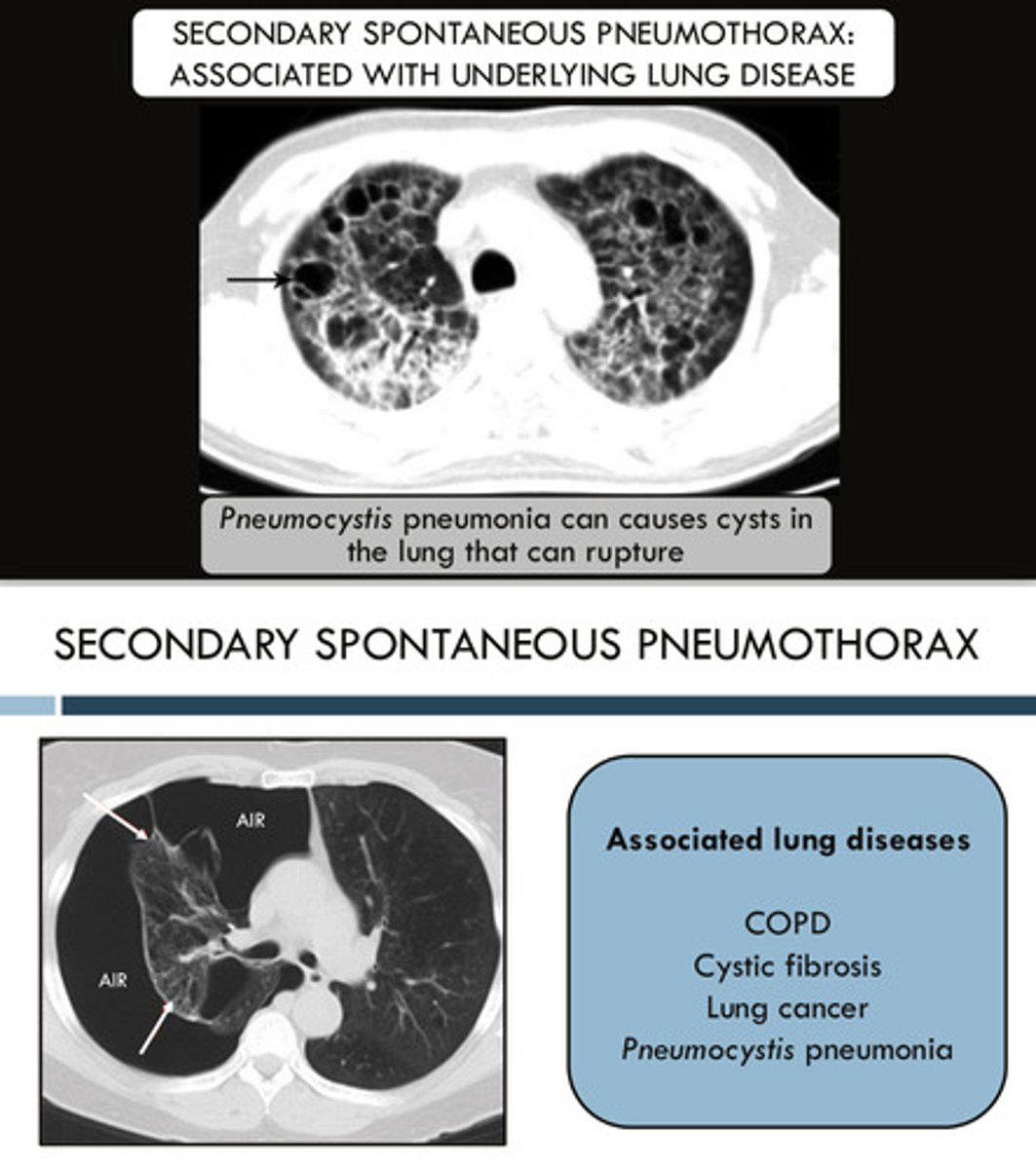 <p>1) COPD</p><p>2) cystic fibrosis</p><p>3) lung cancer</p><p>4) Pneumocystis pneumonia: this can cause cysts in the lungs that can rupture</p>