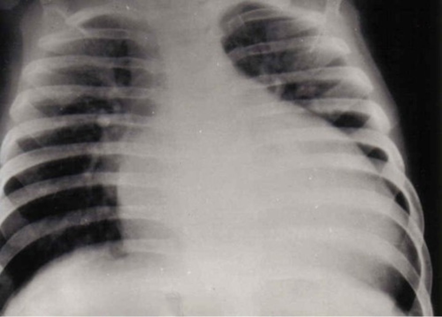 <p>Enlarged heart. (Seen on chest X-rays)</p>