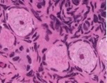 what type of follicle?