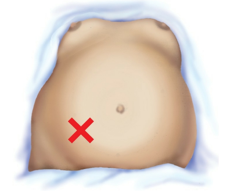 <p>Because the fetus is determined to be in an ROA, a vertex position, the convex portion of the fetus lying closest to the uterine wall would be located in the lower right quadrant of the abdomen. Placing the Doppler ultrasound over that area would produce the loudest fetal heart sounds.</p>