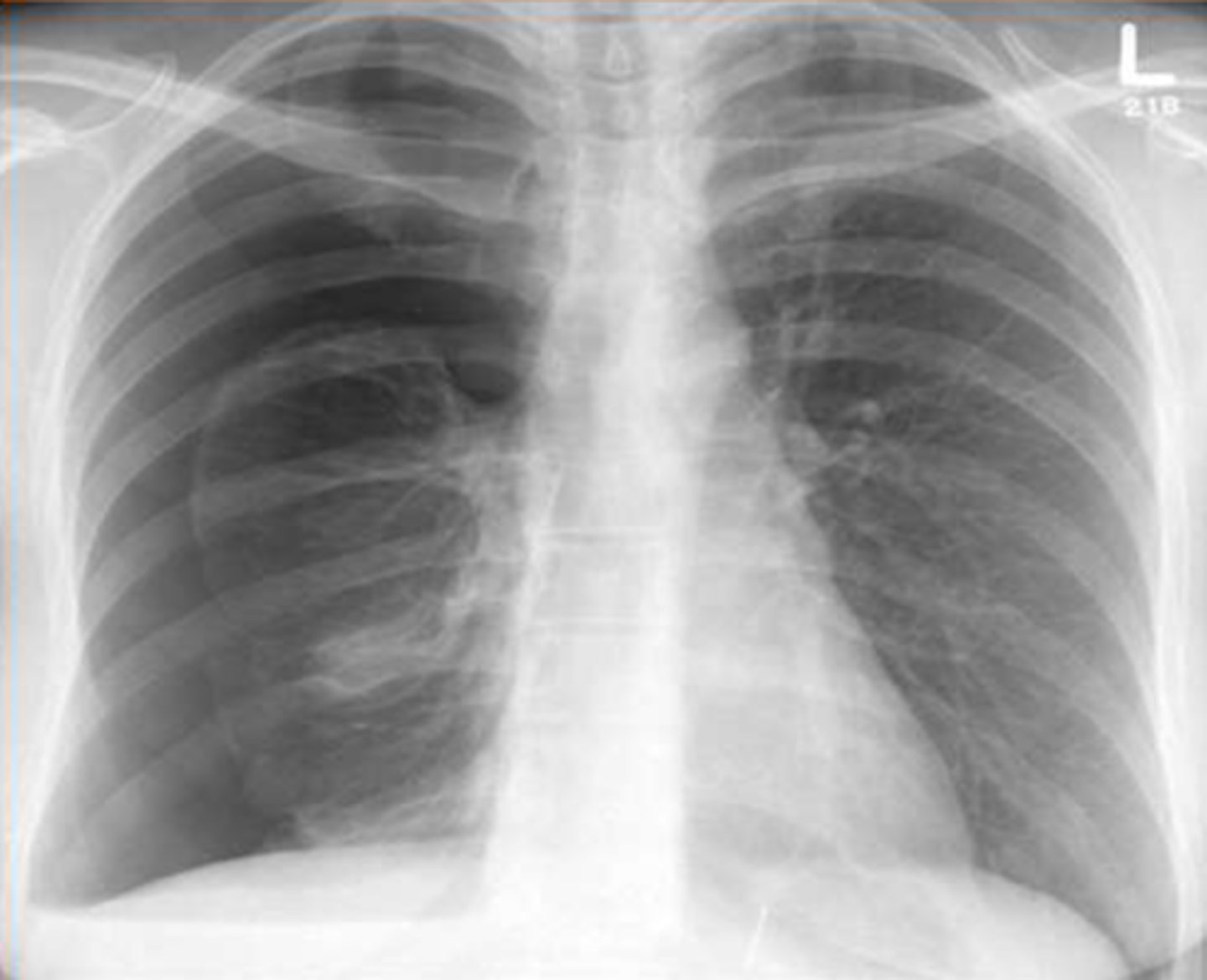 <p>Thin visceral pleural line lying parallel to the chest wall separated by a radiolucent band containing no lung markings</p>