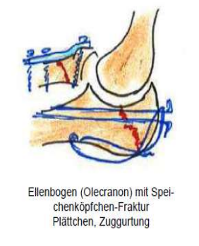 <p>Ellenbogenverletzung</p><p></p>