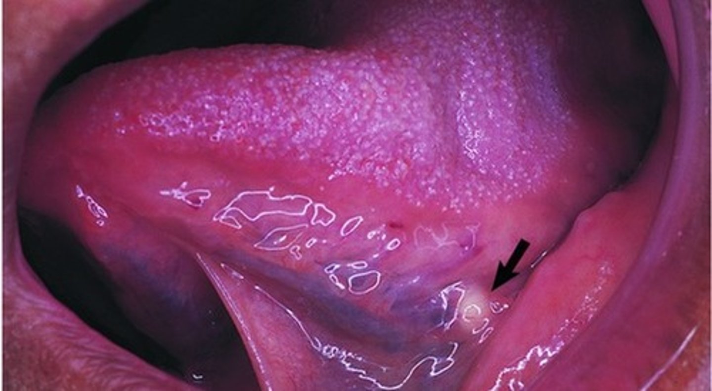 <p>Salivary gland stone; May be found in minor & major salivary glands; Formed by precipitation of calcium salts around a central core; May often be seen on radiographs </p>
