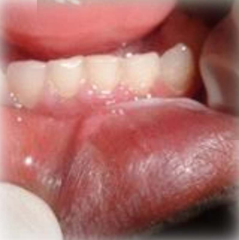 <p>Localised or widespread, white nonaderent plaques and erythematous erosions or ulcers</p><p class="has-focus">Tender/Painful</p><p class="has-focus">First and second decades</p><p class="has-focus">No gender bias</p><p class="has-focus"><strong>Found on:</strong></p><p class="has-focus">Any site, common on lips, tongue buccal mucosa, gingiva</p><p class="has-focus"></p><p class="has-focus is-empty">Ask: Use of any topical medicine/chemicals or mouth rinse?</p>