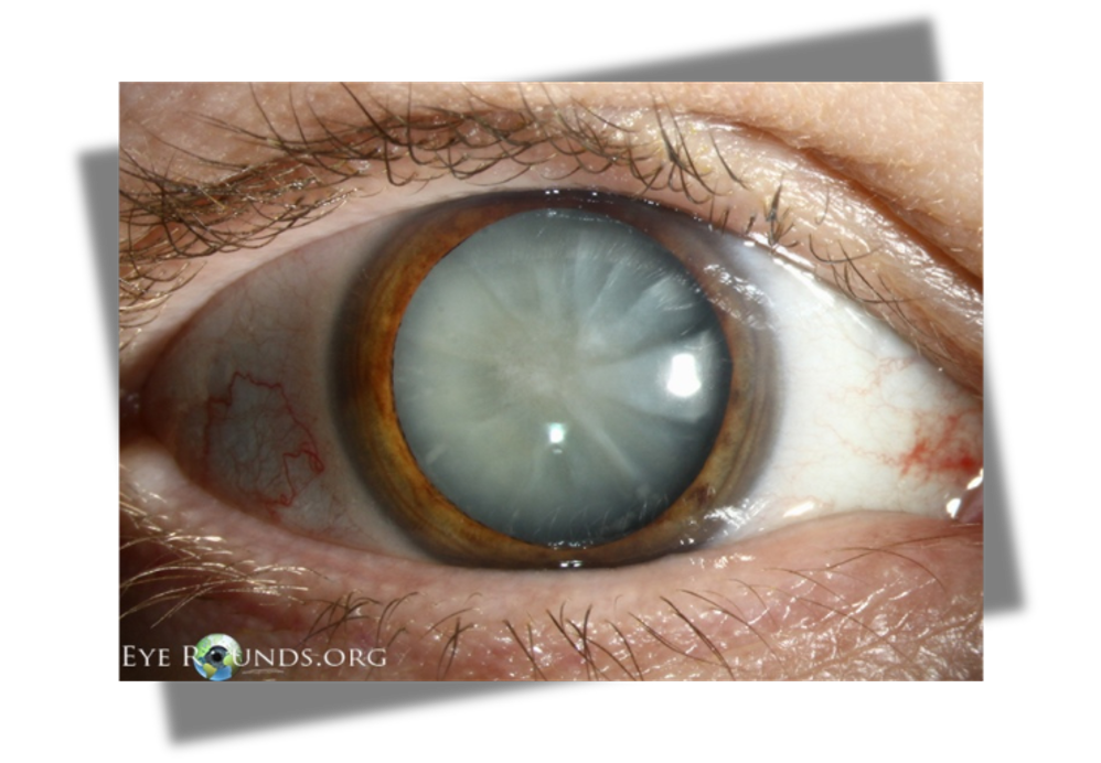 <p>gradual progression of blurred vision more common in &gt; 60 y.o</p>