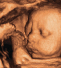 <p>Sonography</p>