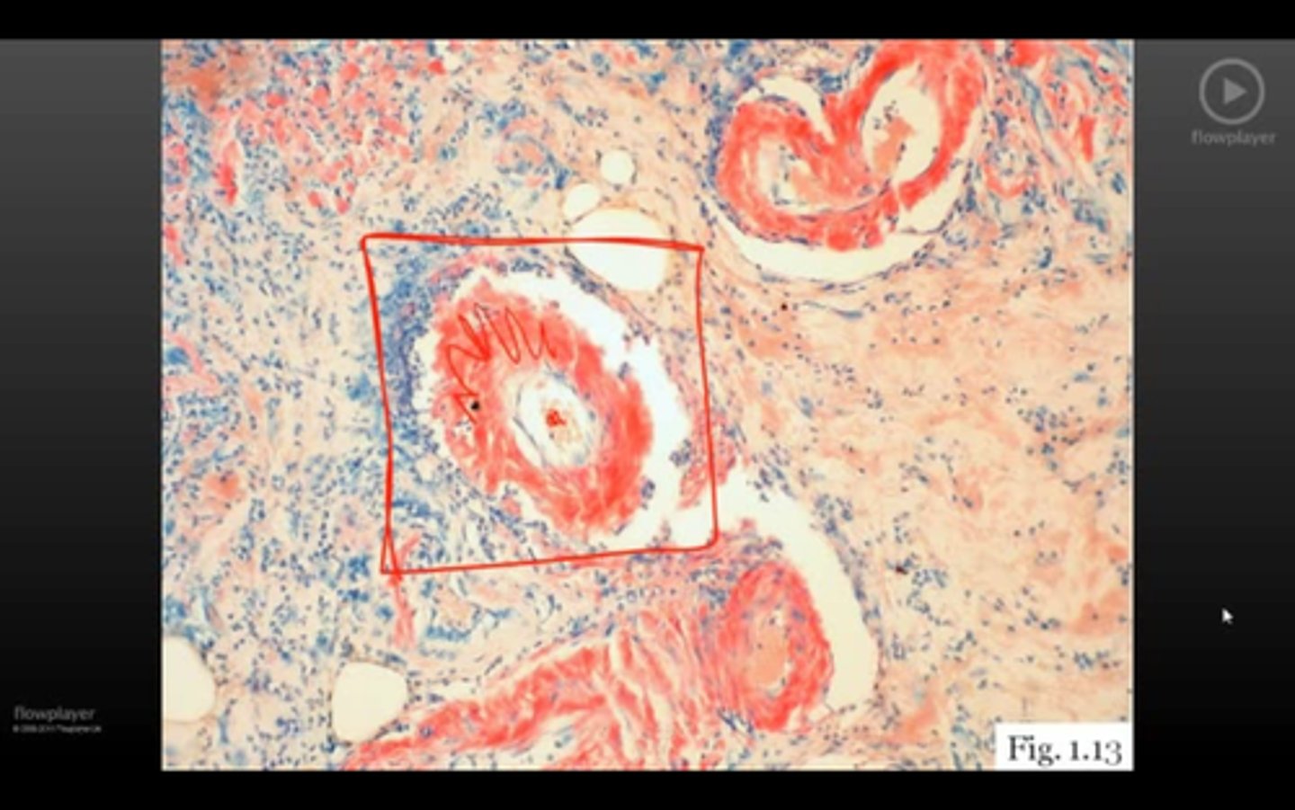<p>identify what's around blood vessel</p><p>-classic Dz</p>