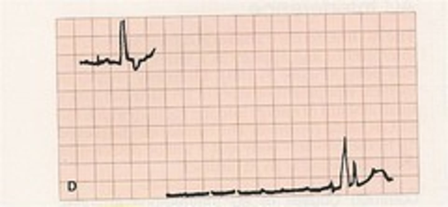 <p>interrupted baseline</p>