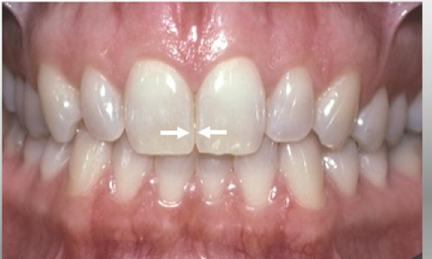 <p>The surfaces next to each other when teeth are adjacent in the arch</p>