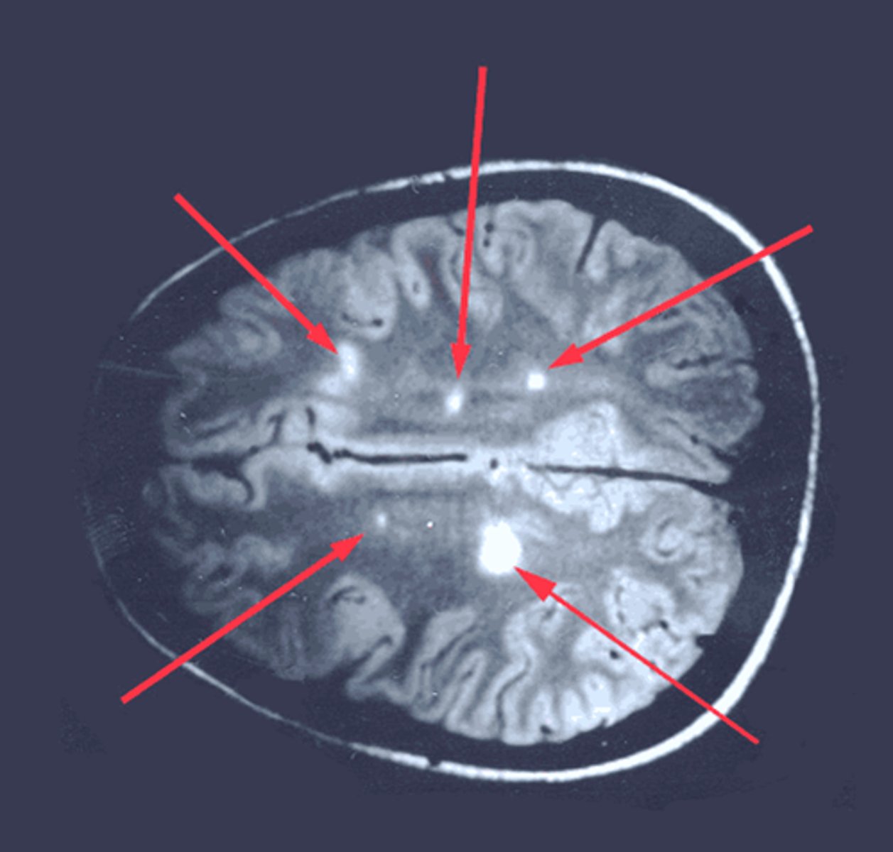 <p>Type IV hypersensitivity</p><p>Dx: Oligoclonal IgG bands and periventricular plaques on MRI</p>