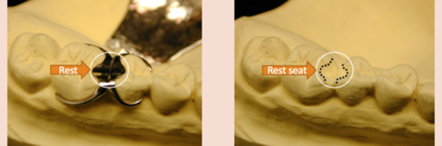 <p>RPD Components - Clasp Assembly Components:</p><p>Fits into a rest seat, which is a planned preparation on an abutment tooth. May be part of a clasp assembly (direct retainer), or may serve as an indirect retainer</p>