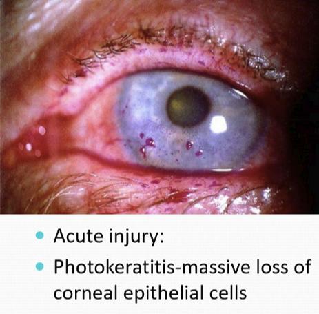 <p>Photokeratitis: massive loss of corneal epithelial cells </p>
