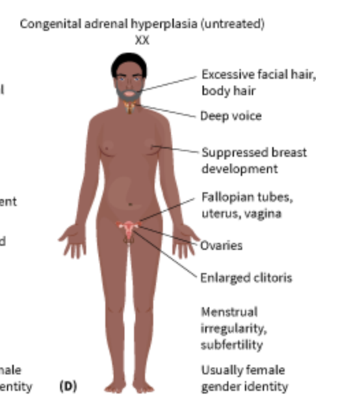 <p><span>1 in 13,000; overabundance of male hormones that cause the clitoris to become enlarged and a partially fused labia and infertility. </span></p>