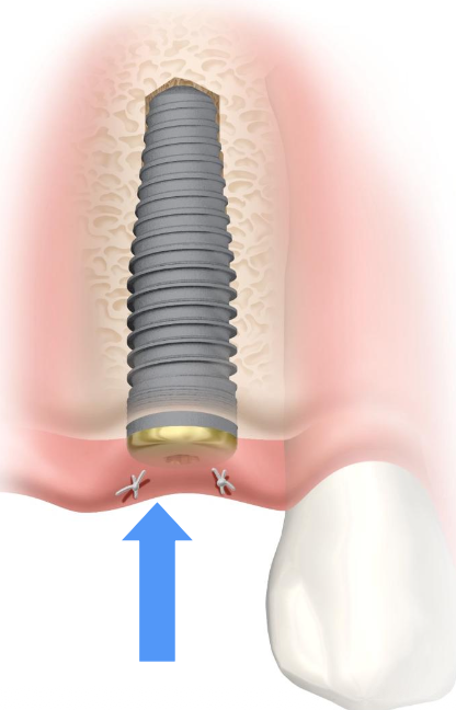 <p>Why must an implant be protected during healing?</p>