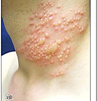 <p>Which Herpes variant is this?</p>