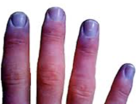 <ul><li><p><strong>CAUSE&nbsp;</strong></p><ul><li><p>Inadequate O<sub>2</sub> delivery to tissues&nbsp;&nbsp;</p></li></ul></li><li><p><strong>EFFECT&nbsp;</strong></p><ul><li><p>Cyanosis </p></li></ul></li></ul><p></p>