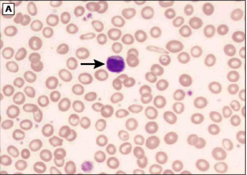 <p>Labs for Iron deficiency anemia</p>