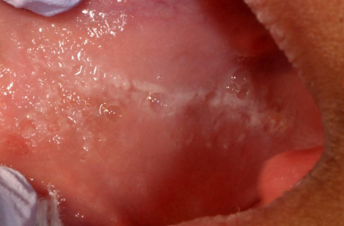 <p>irregular ragged surface or corrugate white lesion most frequently of buccal mucosa </p>