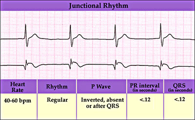 <p>no p wave-&gt; atria/SA node not working, irregular heart rate</p>