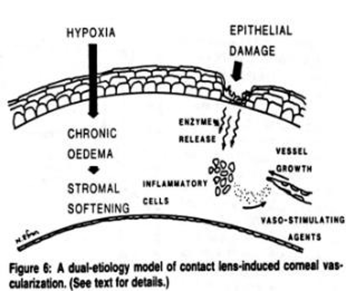 <p>Corneal swelling, premature desquamation, decreased healing rates, decreased corneal sensitivity, and vascularization.</p>