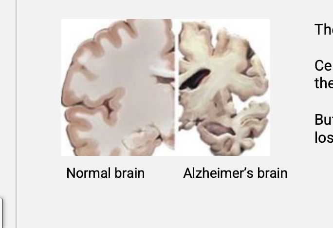 <ul><li><p>neurodegenerative disease</p></li><li><p>over time, certain nerves die</p></li><li><p>NO cure for alzheimers</p></li><li><p>certain drugs can temporarily help with some of the symptoms but there are NO drugs that prevent or delay the loss of neurons</p></li></ul><p></p>
