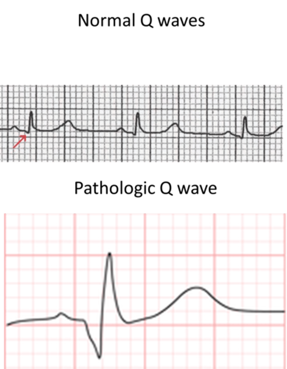 <p>- Q wave &gt;0.04 sec</p><p>- Q wave is present in lead that usually has an initial R wave (i.e., V2 or V3)</p><p>- Q wave amplitude &gt;25% of the following R wave</p>