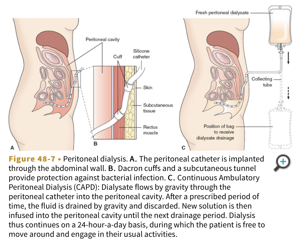 <p></p><ul><li><p>Removal of toxic substances and wates for patients unable to undergo HD or transplantation</p></li><li><p>Peritoneal membrane thatcovers the abdominal organs and lines the abdominal wals serves as the semipermiable membrane</p></li><li><p>Sterile dialysate fluid with dextrose and electrolytes is put into the peritoneal cavity through a catheter</p></li><li><p>Toxins begin to clear from the blood</p></li><li><p>Diffusion</p></li><li><p>Clearance</p></li><li><p>Ultrafiltation</p></li></ul>