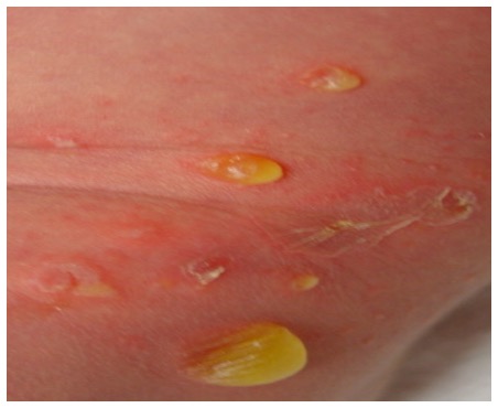<p>vesicles that fill w/ yellow fluid, commonly on the trunk; </p><p>highly contagious; most common ages 2-5; s. aureus</p>