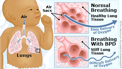 <p>chronic lung disease that affects predominantly preterm infants, resulting from underdeveloped lungs that become easily irritated or inflamed. </p>