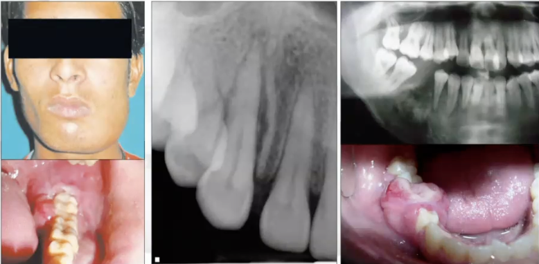 <p>Osteosarcoma</p>