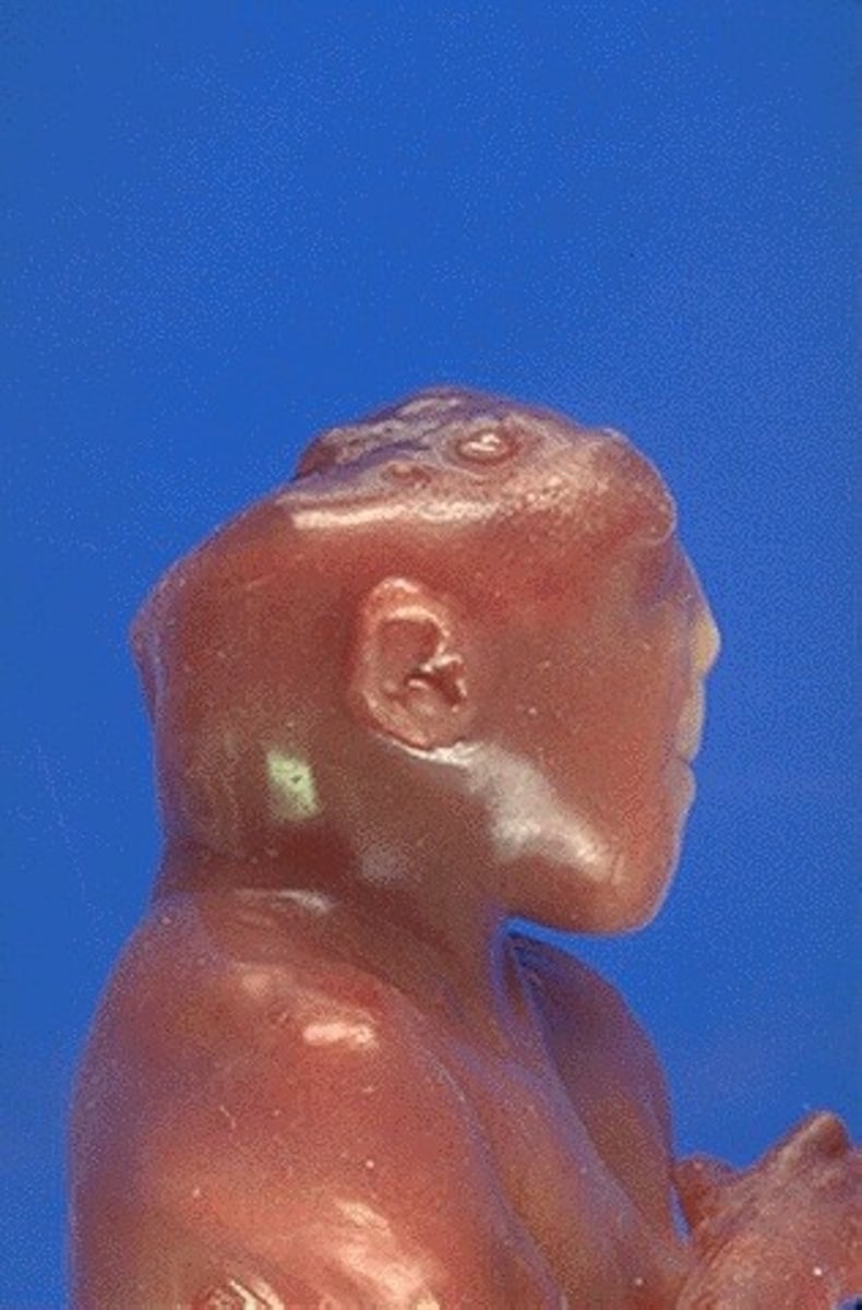 <p>defect in closure of the cephalic portion of the neural tube that results in incomplete development of the brain and bones of the skull</p>