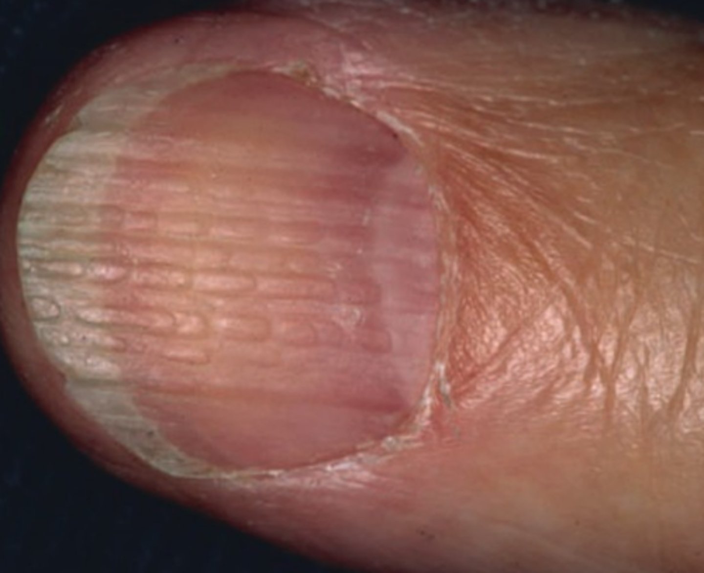 <p>= splitsen van distaal deel van de nagel</p>