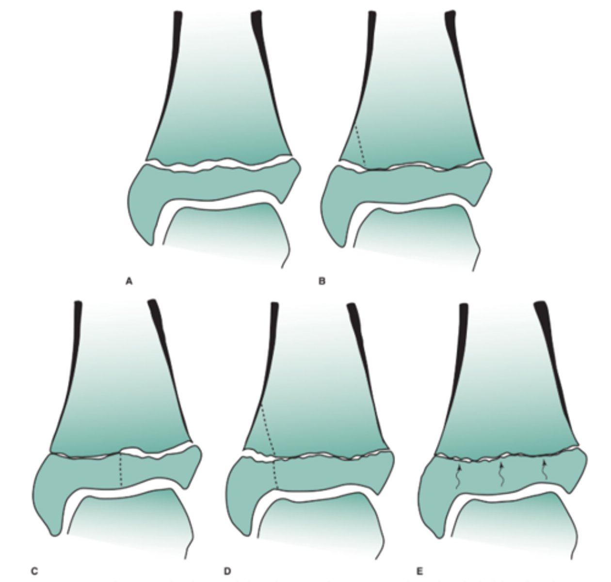 <p>SALTER-HARRIS - Physeal Injuries</p><p>(SALTR - Same, Above, Lower, Through, Really bad)</p><p>1 - fracture through physis</p><p>2 - fracture through physis into metaphysis</p><p>3 - intra-articular fracture through physis into epiphysis</p><p>4 - intra-articular fracture through epiphysis, physis, and metaphysis 5 - crush injury</p>