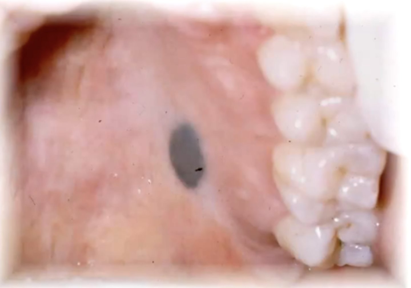 <p>a mole</p><p>these are rare to find in the oral cavity</p>