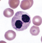 <p>Identify the form of Pelger Huet anomaly according the the following characteristics:</p><ul><li><p>Bi-lobed nucleus</p></li><li><p>Dense heterochromatin</p></li><li><p>Incomplete nuclear segmentation</p></li><li><p>Dumbbell or pince-nez morphology</p></li></ul><p></p>