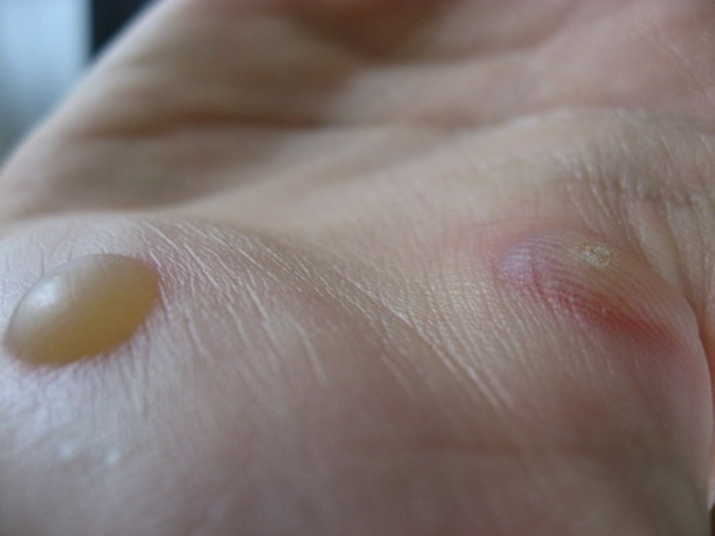 <p>1. Spongiosis</p><p>2. Acantholysis</p><p>3. Cytolysis</p><p>4. Subepidermal blister formation</p><p>5. Mechanical blister formation</p>