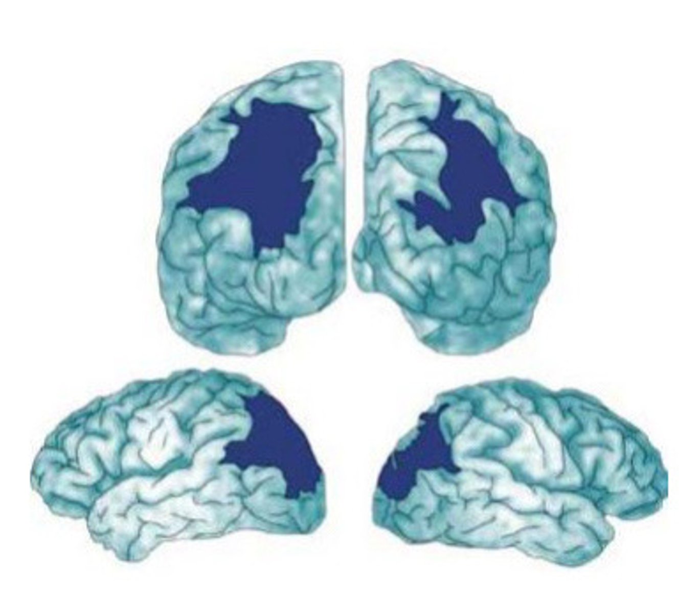 <p>severe disruption of attention and explicit spatial awareness based on large region of brain damage</p><p>characterized by:</p><p>1. oculomotor apraxia</p><p>2. optic ataxia</p><p>3. simultanagnosia</p><p>e.g. cannot locate items they see and can’t tell when item is moved toward or away from them</p>