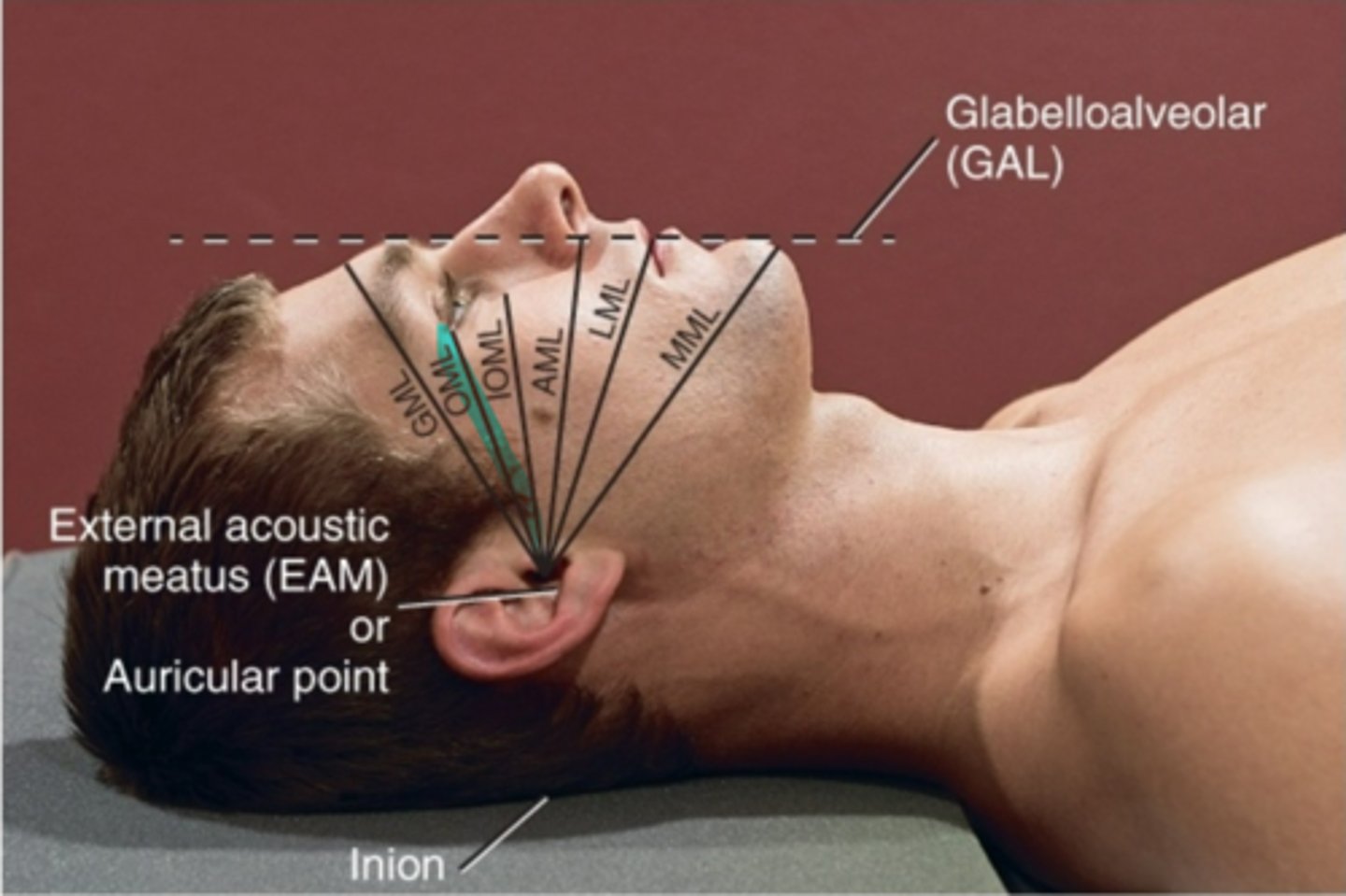 <p>orbital meatal line</p>